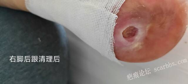 2025年李高令接治2023年低温烫伤的老人（青岛） 