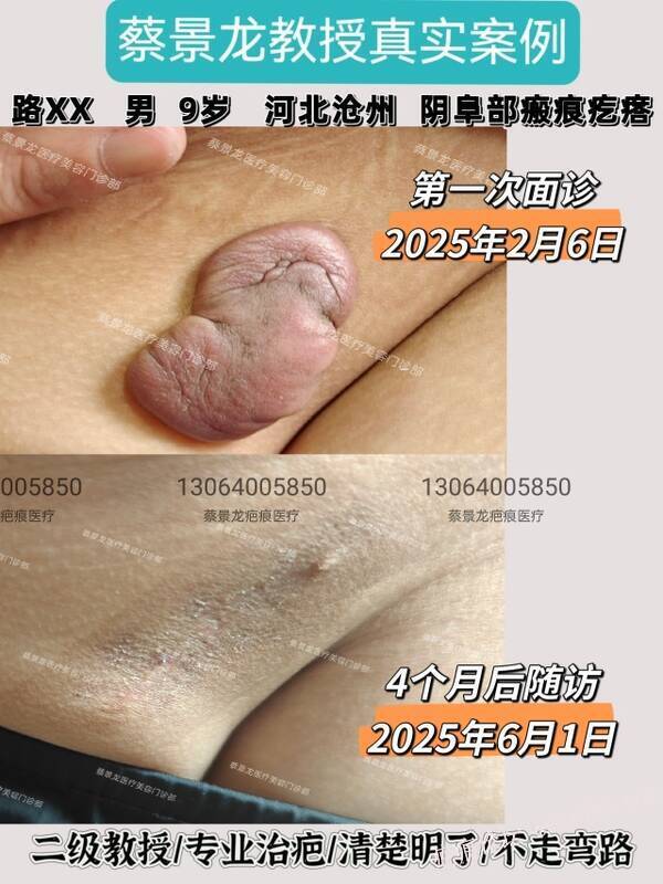 儿童做手术后长了疤痕疙瘩
