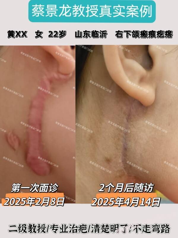 面颈部术后疤痕疙瘩