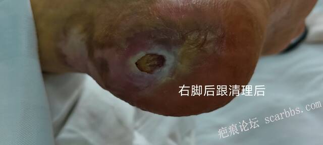 2025年李高令接治2023年低温烫伤的老人（青岛） 