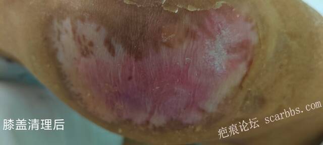 2025年李高令接治2023年低温烫伤的老人（青岛） 