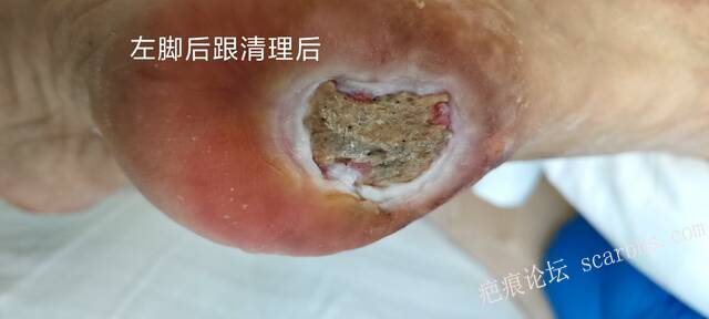 2025年李高令接治2023年低温烫伤的老人（青岛） 