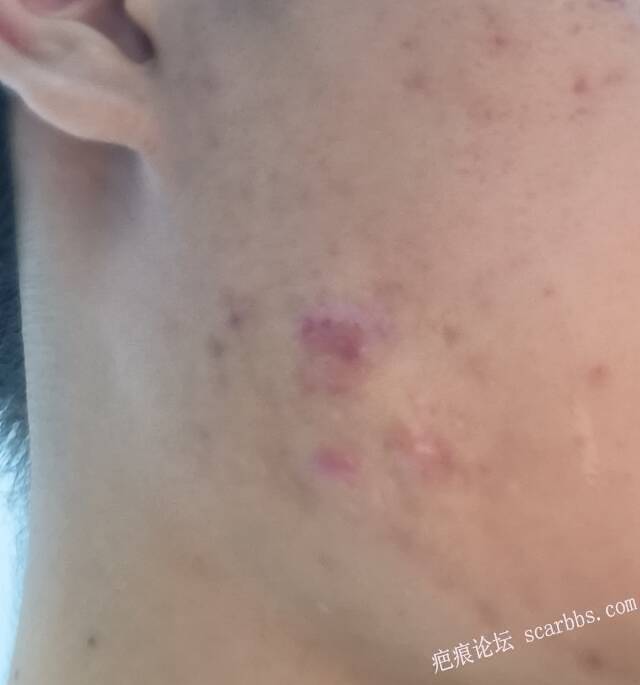 痤疮留下的疤痕，快1年了