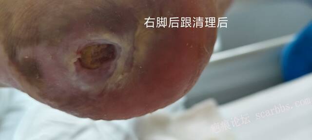 2025年李高令接治2023年低温烫伤的老人（青岛） 