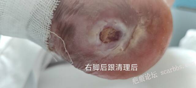 2025年李高令接治2023年低温烫伤的老人（青岛） 