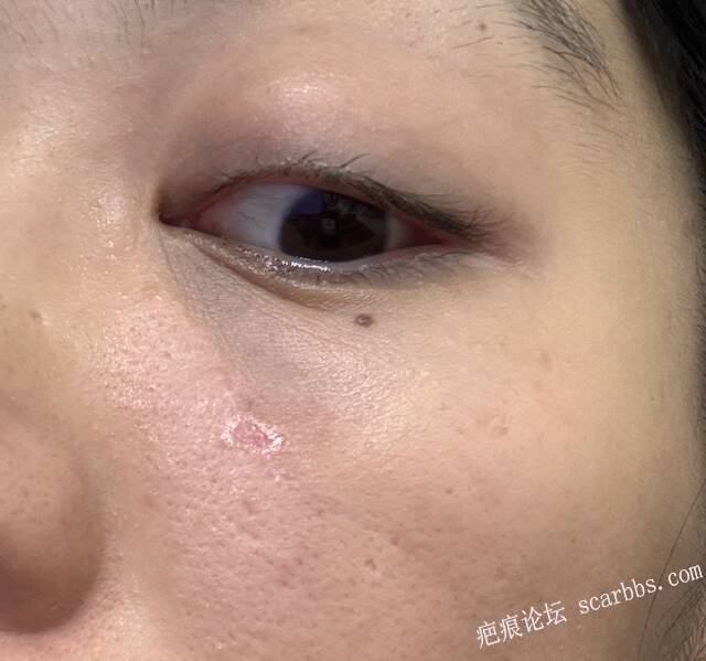脸上拆线四天了手术刀口凹陷 