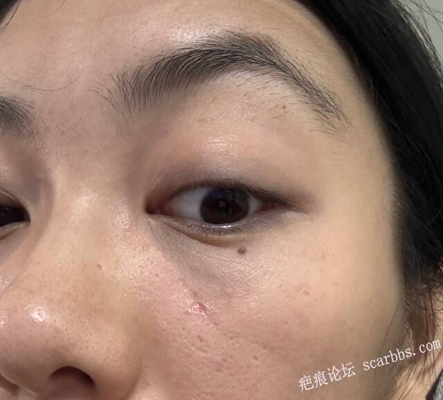 脸上拆线四天了手术刀口凹陷 