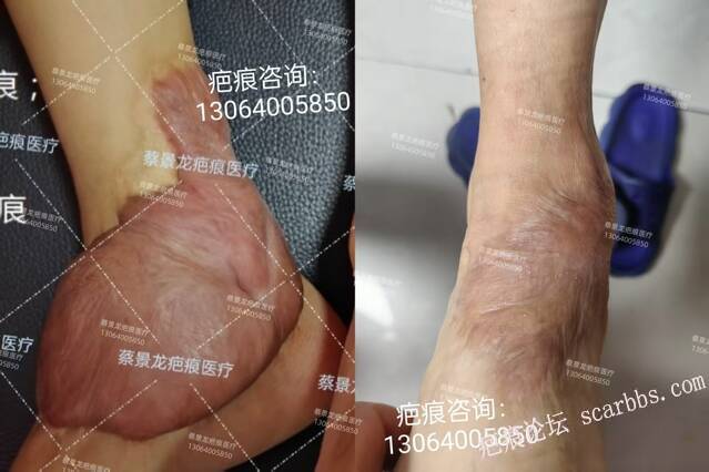 7岁孩子足部长出这么大的疤痕疙瘩