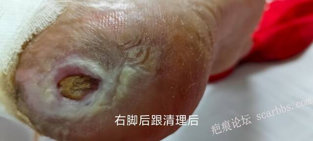 2025年李高令接治2023年低温烫伤的老人（青岛） 