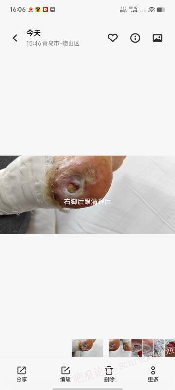2025年李高令接治2023年低温烫伤的老人（青岛） 