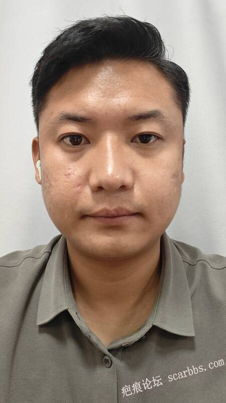 怎么办，都是痘坑！ 