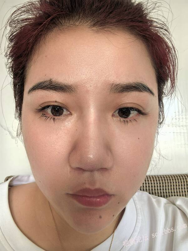 4月26日杨教授手术切除眼睛下边疤痕 