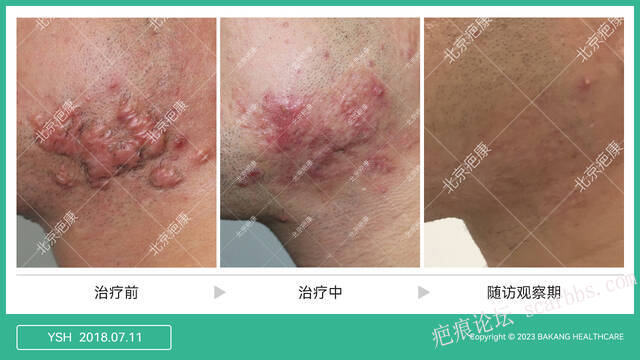 疤痕疙瘩怎么治效果好，牢记这六点 