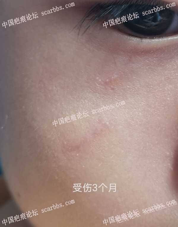 意外磕伤，开帖记录抗疤过程 
