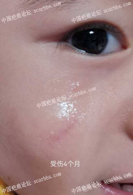 意外磕伤，开帖记录抗疤过程 