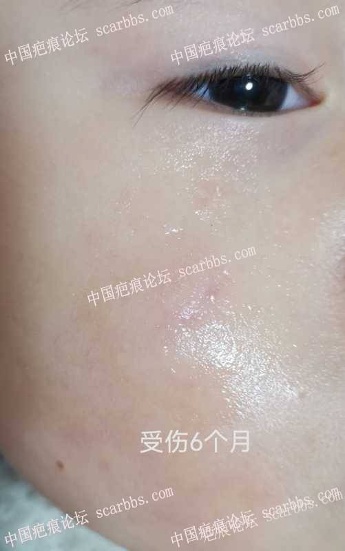 意外磕伤，开帖记录抗疤过程 