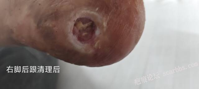 2025年李高令接治2023年低温烫伤的老人（青岛） 