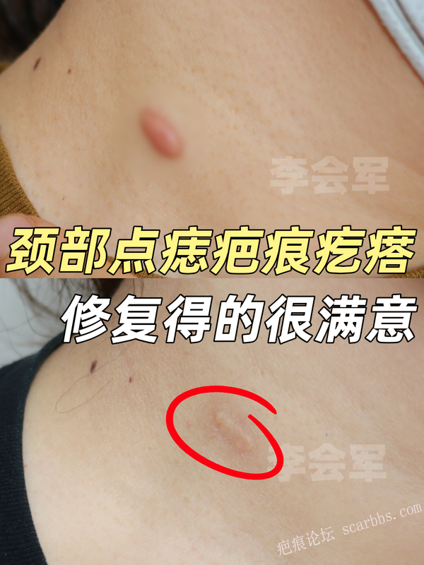 颈部点痣疤痕疙瘩