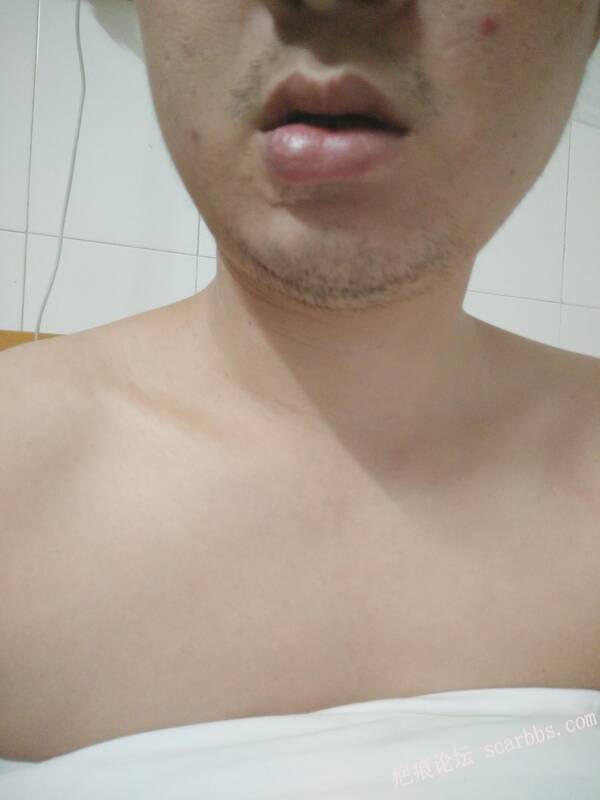 初来贵论坛，宝宝眼睛上面磕伤，求助大家！ 