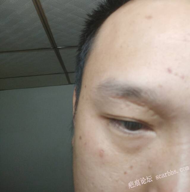 这种凹陷型的疤痕能不能去掉好烦啊 