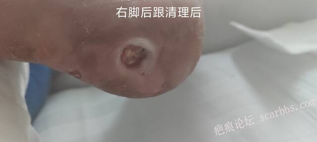 2025年李高令接治2023年低温烫伤的老人（青岛） 