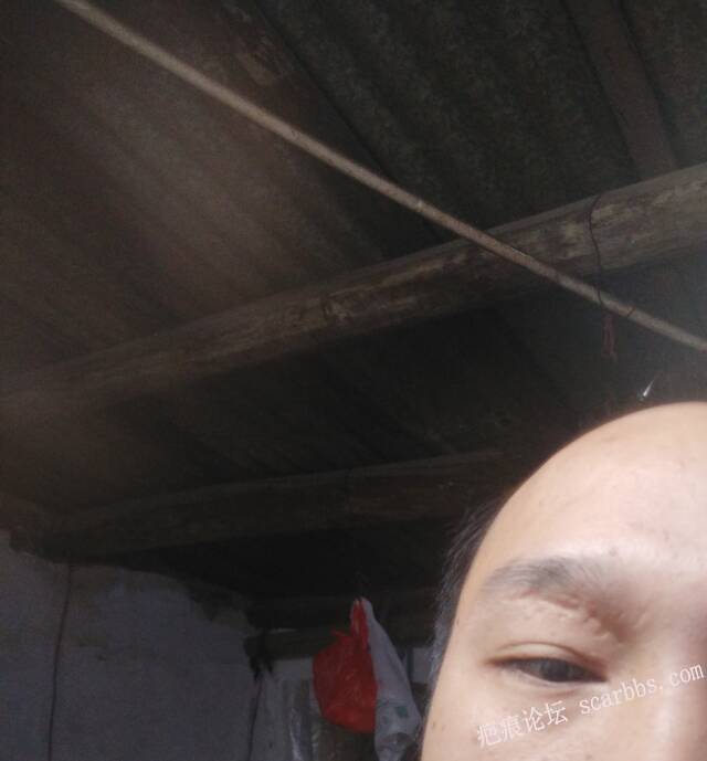 眼皮疤痕