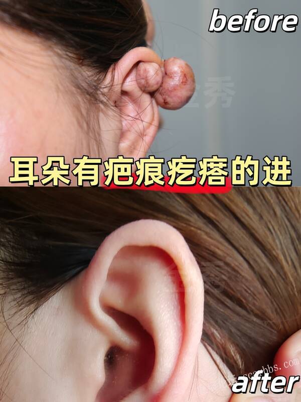 耳朵疤痕疙瘩恢复的很美观