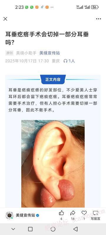 疤痕疙瘩 
