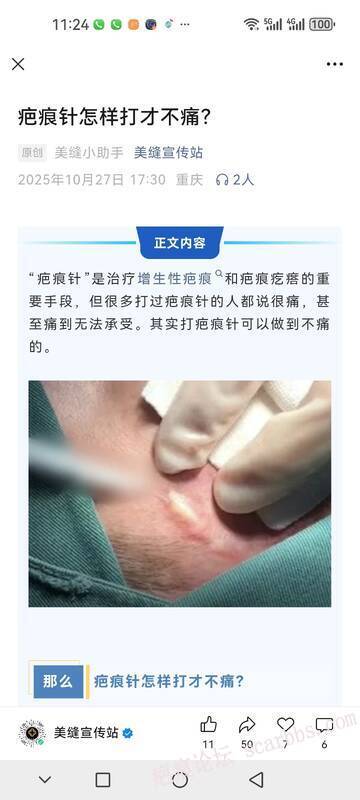 打疤痕针很痛吗？怎么打才不痛呢？