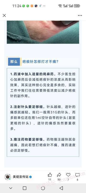 打疤痕针很痛吗？怎么打才不痛呢？ 