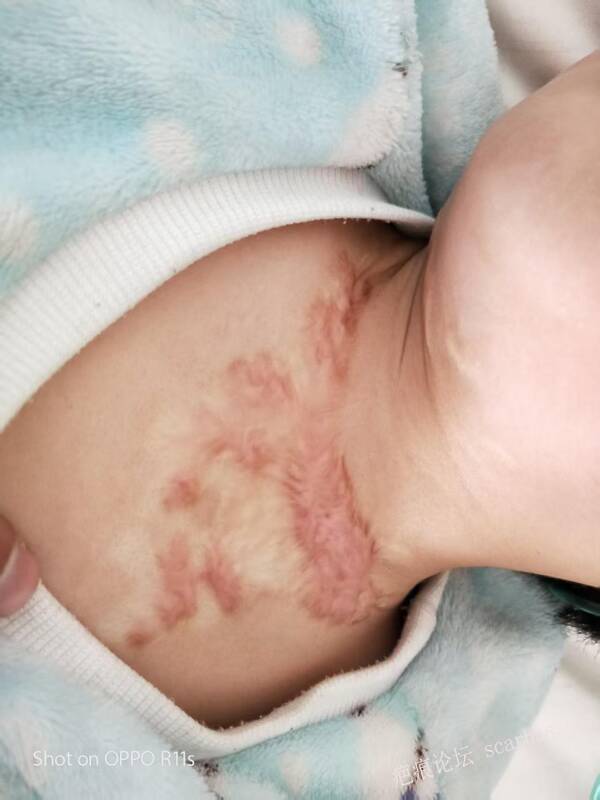 烧伤疤痕怎么治疗