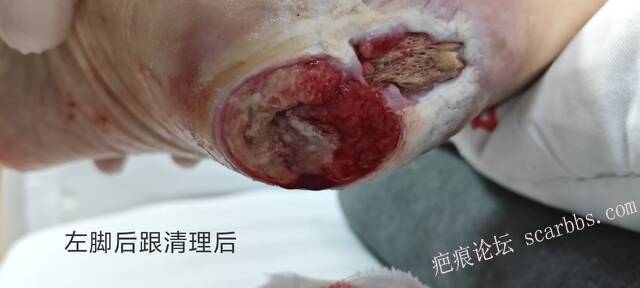 2025年李高令接治2023年低温烫伤的老人（青岛） 