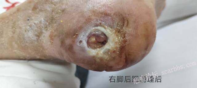 2025年李高令接治2023年低温烫伤的老人（青岛） 