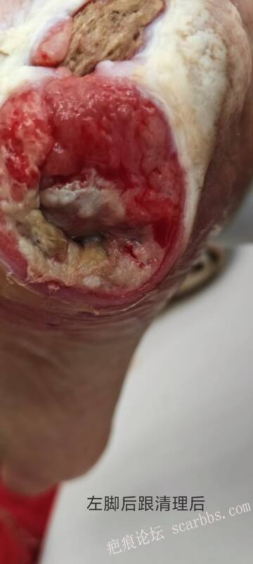 2025年李高令接治2023年低温烫伤的老人（青岛） 