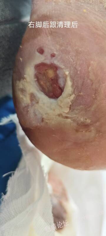 2025年李高令接治2023年低温烫伤的老人（青岛） 