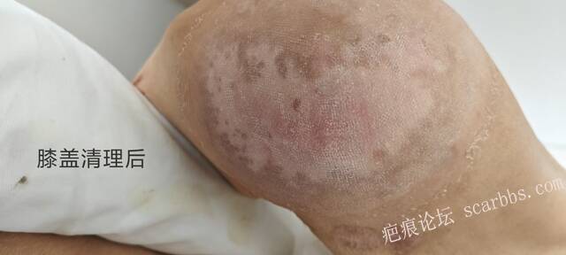 2025年李高令接治2023年低温烫伤的老人（青岛） 