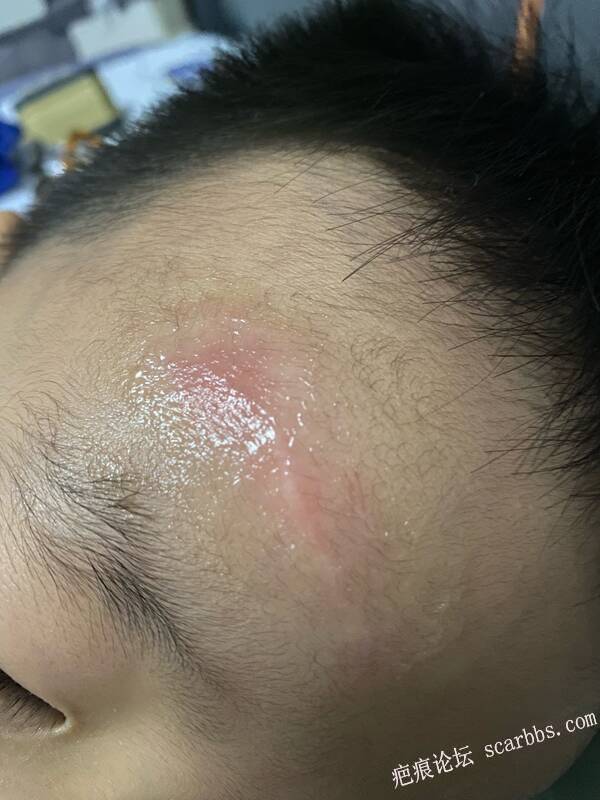 磕伤缝针，一年半疤痕发痒