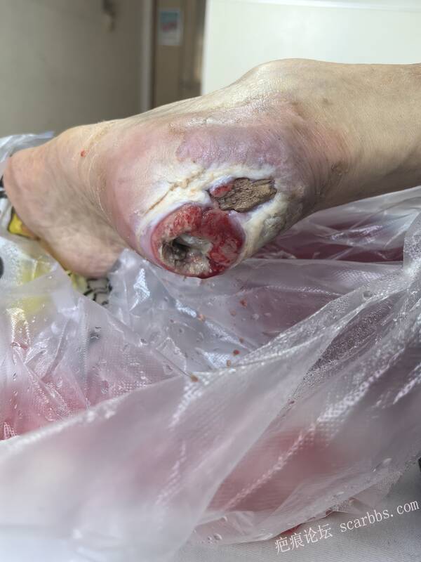 2025年李高令接治2023年低温烫伤的老人（青岛） 