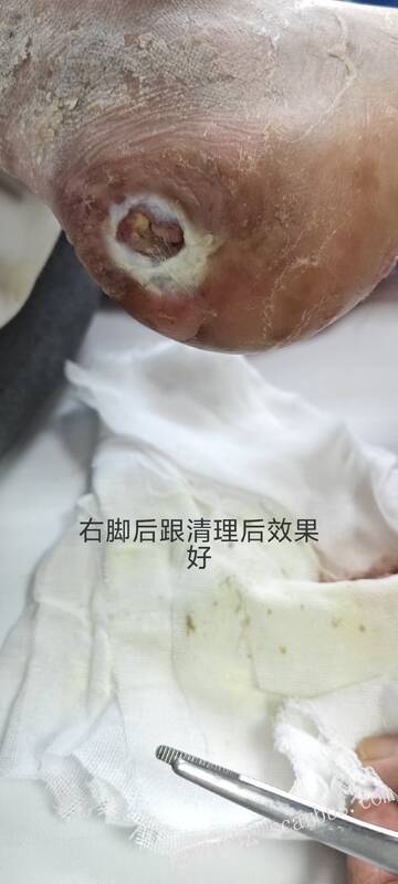 2025年李高令接治2023年低温烫伤的老人（青岛） 