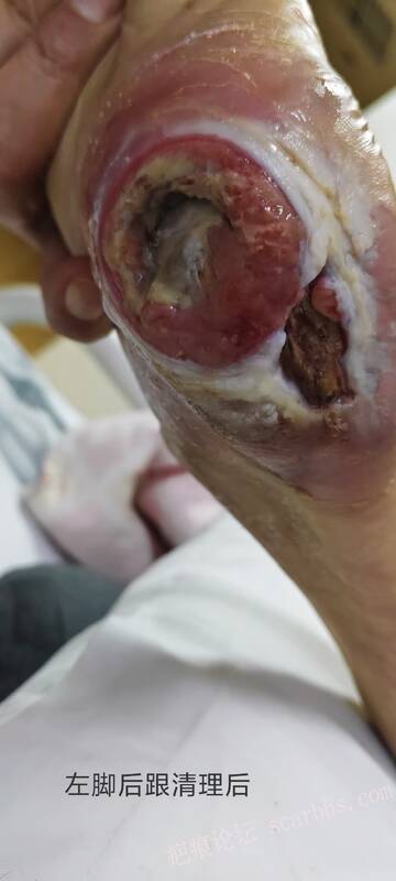 2025年李高令接治2023年低温烫伤的老人（青岛） 