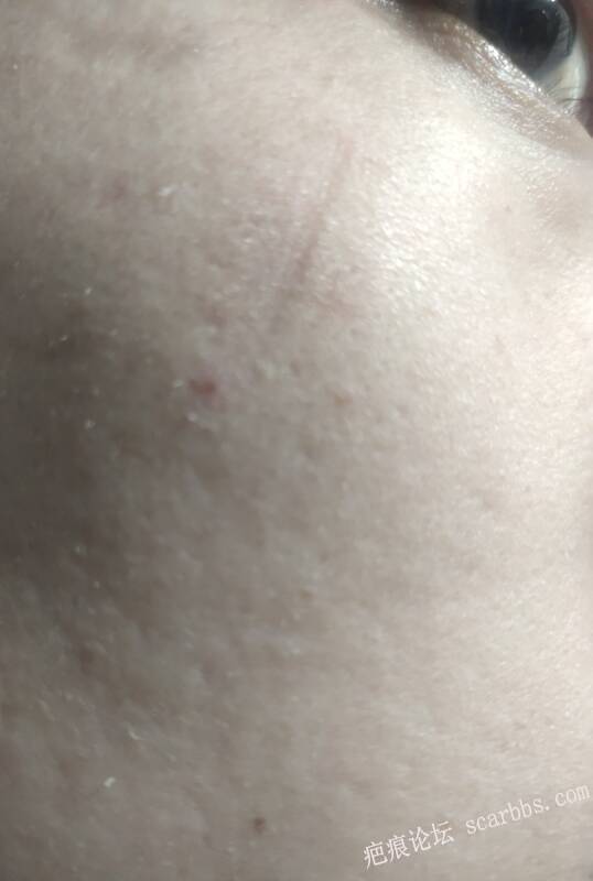 点阵激光治疗凹陷疤痕 