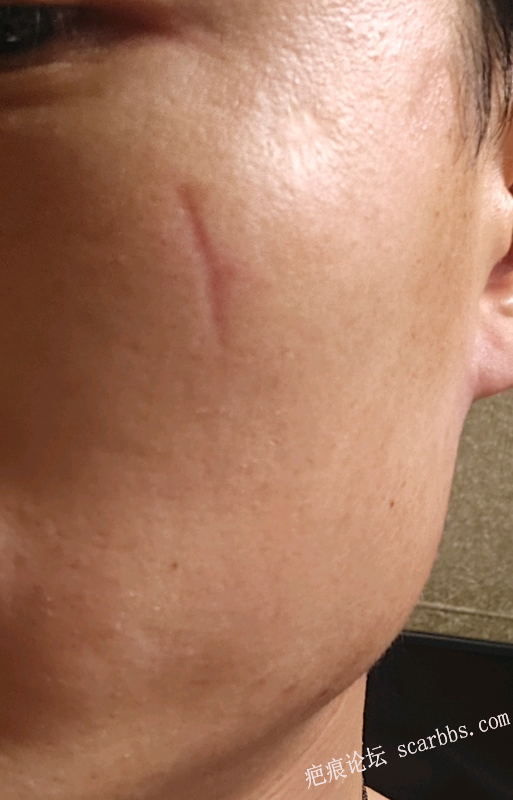 点阵激光治疗凹陷疤痕 