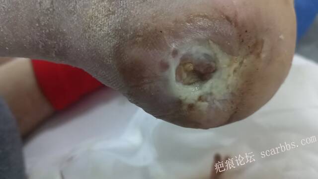 2025年李高令接治2023年低温烫伤的老人（青岛） 