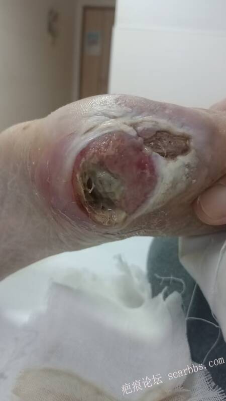 2025年李高令接治2023年低温烫伤的老人（青岛） 