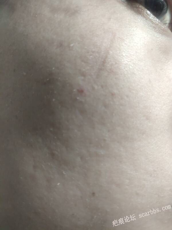 点阵激光治疗凹陷疤痕 