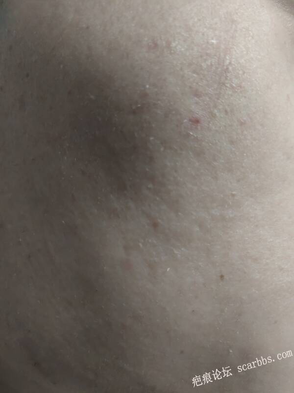 点阵激光治疗凹陷疤痕 