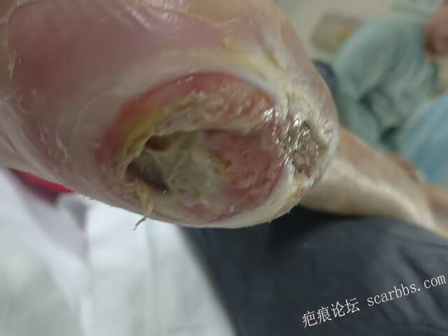 2025年李高令接治2023年低温烫伤的老人（青岛） 