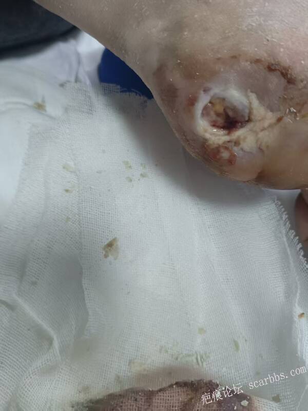 2025年李高令接治2023年低温烫伤的老人（青岛） 