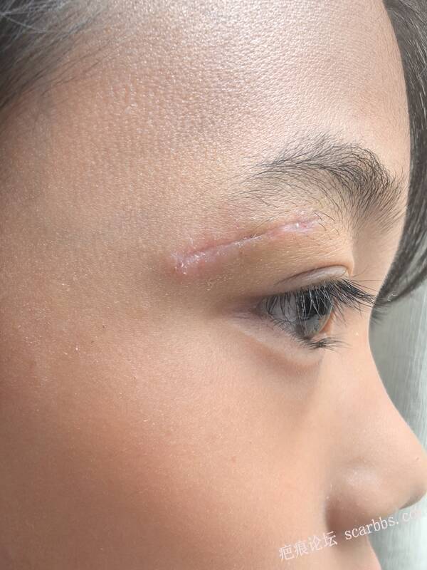 孩子眼皮磕伤，拆线第二天，请问怎么抗疤 