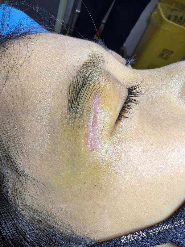 孩子眼皮磕伤，拆线第二天，请问怎么抗疤 